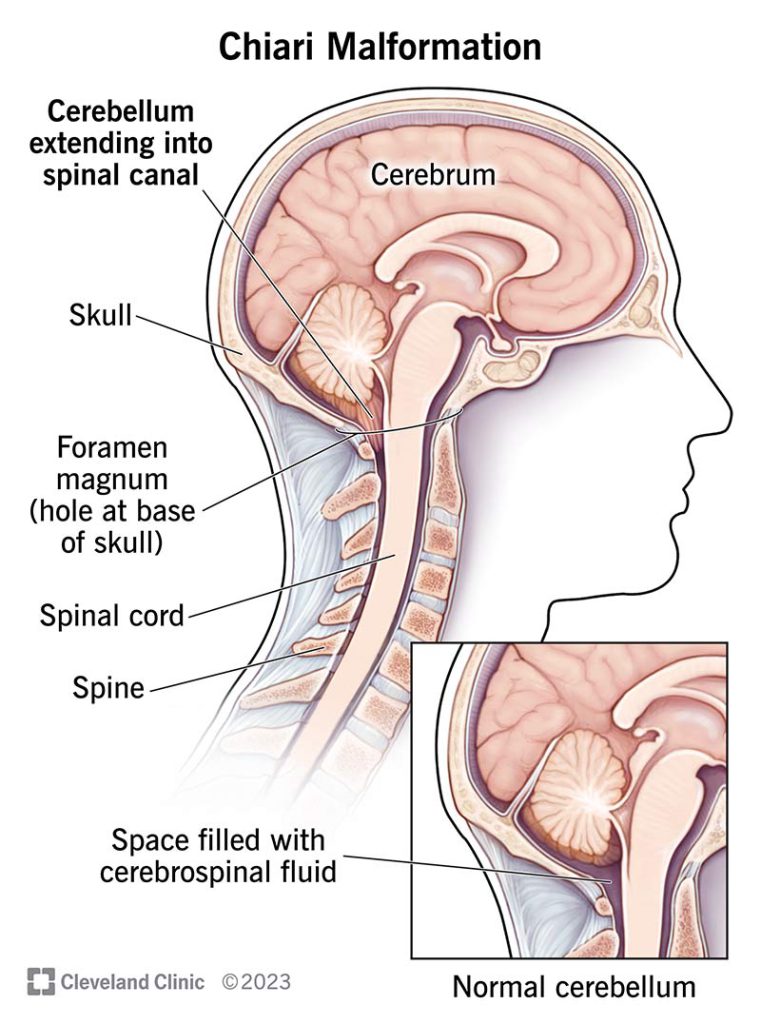 Chiari Malformacija