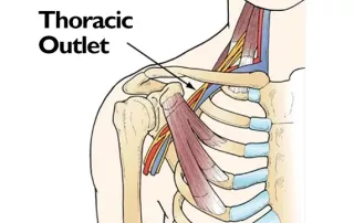 Krūtinės atvaros sindromas