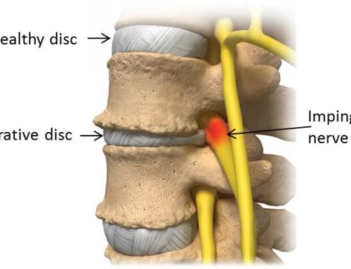 Tarpslankstelinio disko degeneracija
