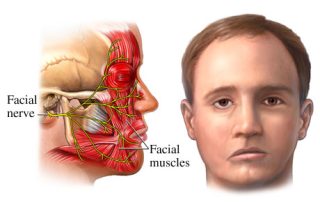 Veidinio nervo neuropatija