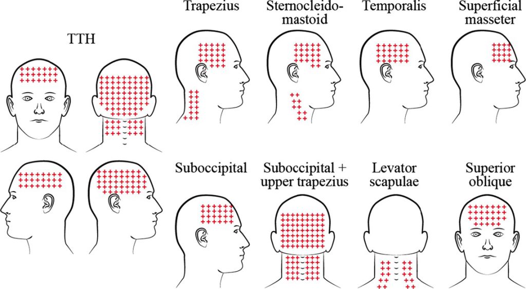 Miofascijinis galvos skausmas