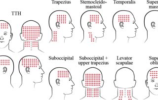 Miofascijinis galvos skausmas