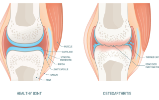 ERGOTERAPIJA SERGANT SĄNARIŲ ARTROZE (OSTEOARTRITU)