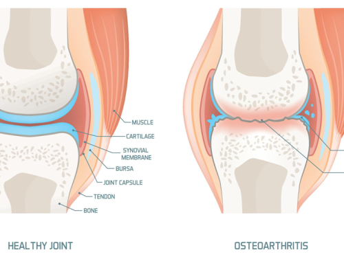 ERGOTERAPIJA SERGANT SĄNARIŲ ARTROZE (OSTEOARTRITU)