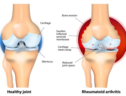 ERGOTERAPIJA SERGANTIEMS ARTRITU