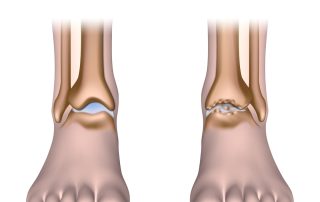 Čiurnos osteoartritas