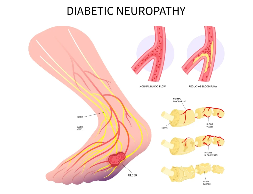Diabetinė neuropatija