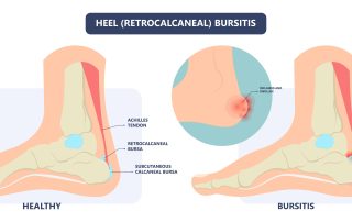Retrokalkaninis bursitas