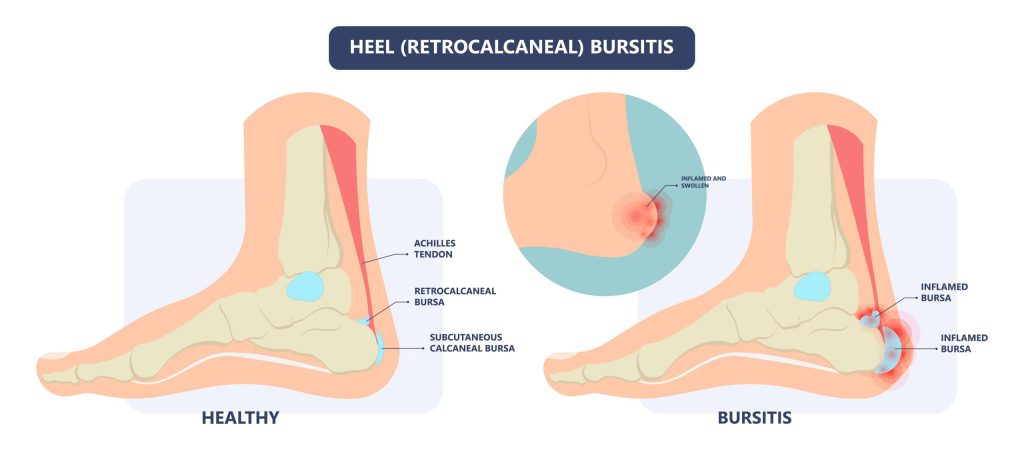 Retrokalkaninis bursitas