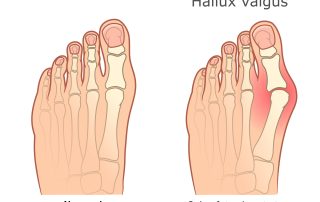 Hallux valgus