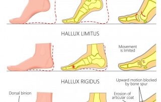 Hallux rigidus
