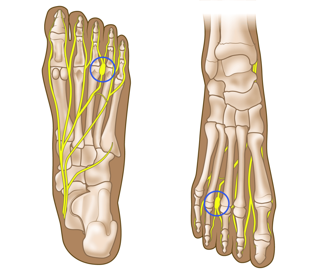 Mortono neuroma