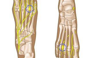 Mortono neuroma