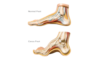 Pes Cavus