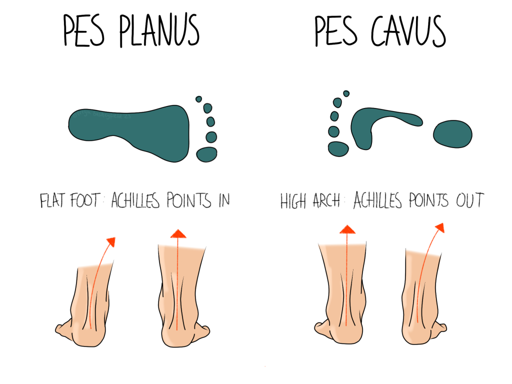 Pes Planus