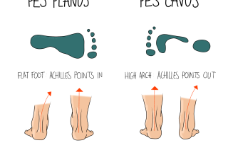 Pes Planus