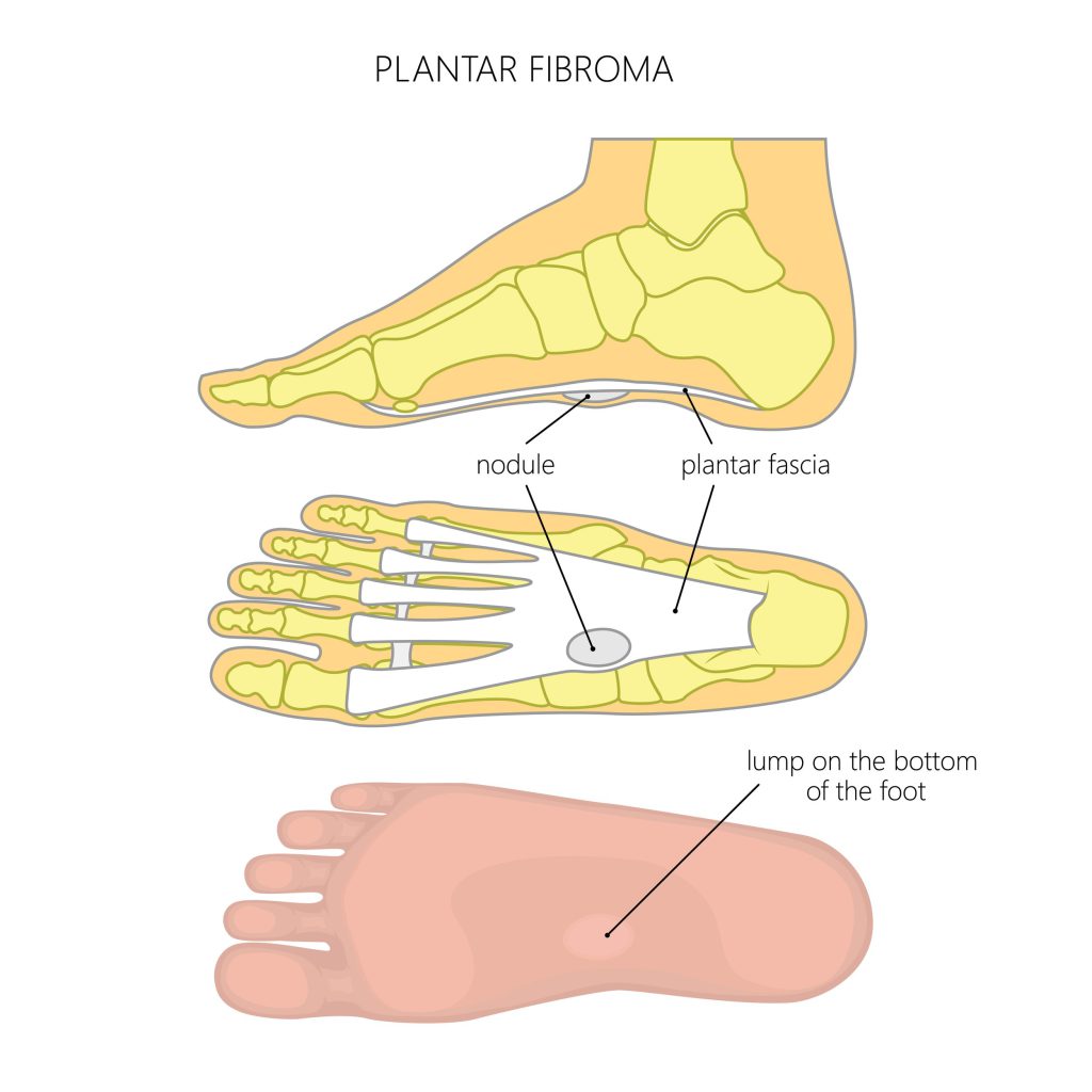 Pado fascijos fibromatozė