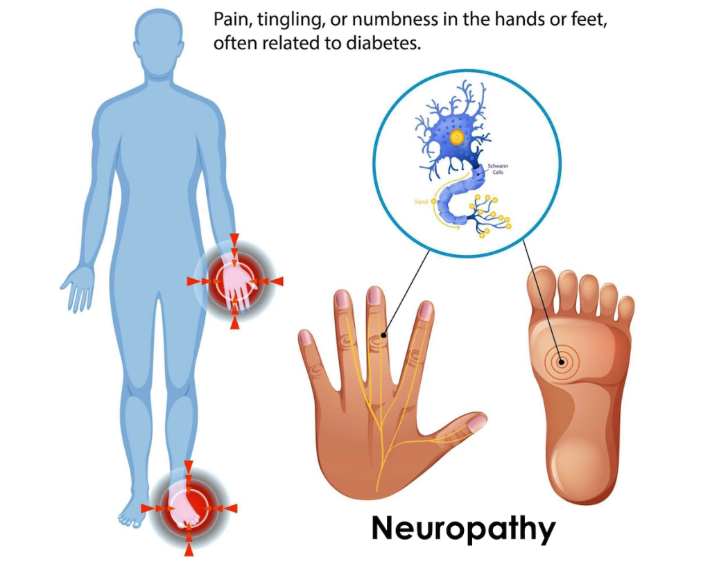 Periferinė neuropatija plaštakose ir pėdose